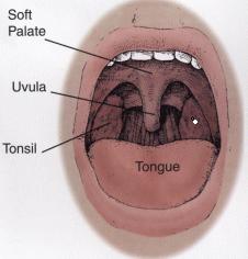 Tonsil Stones